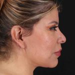 Structural Fat Grafting Before & After Patient #3642
