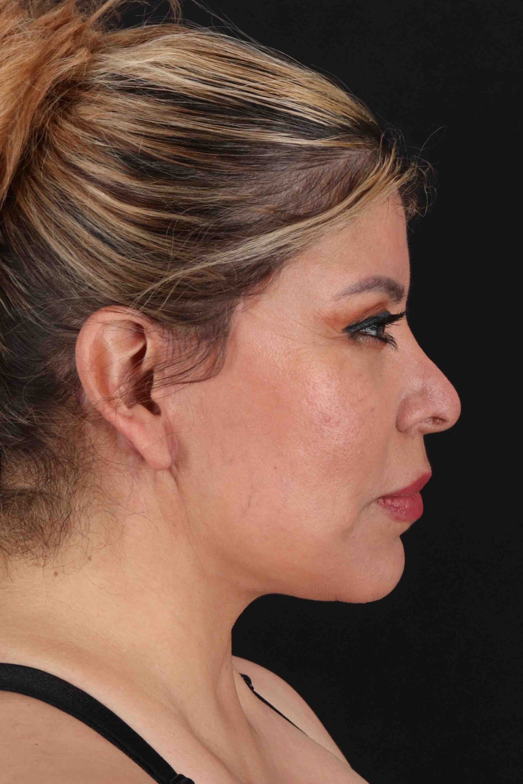 Structural Fat Grafting Before & After Patient #3642