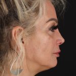 CO2 Laser Before & After Patient #3003