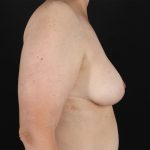 Breast Lift Before & After Patient #3004