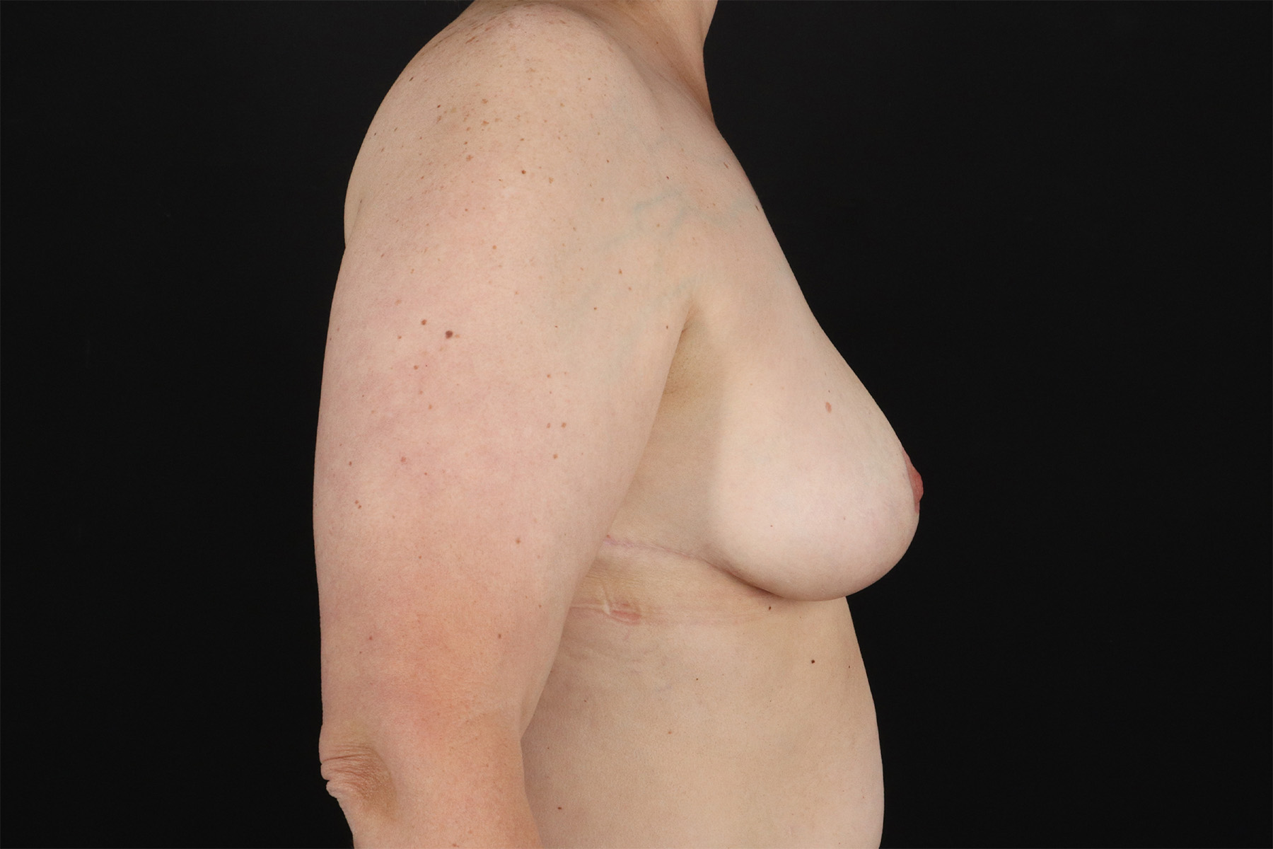 Breast Lift Before & After Patient #3004