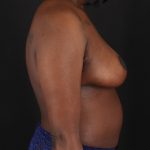 Breast Reduction with Lift Before & After Patient #3472