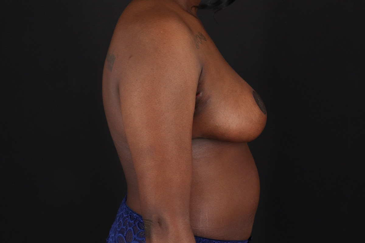 Breast Reduction with Lift Before & After Patient #3472