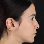 CO2 Laser Before & After Patient #3005