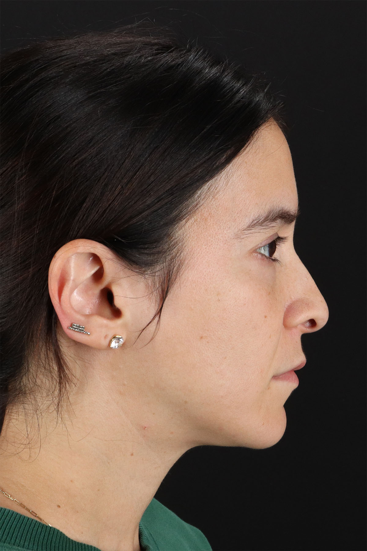 CO2 Laser Before & After Patient #3005