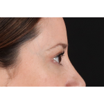 Eyelid Surgery Before & After Patient #3006