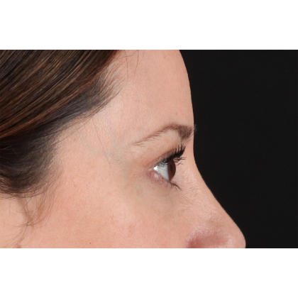Eyelid Surgery Before & After Patient #3006
