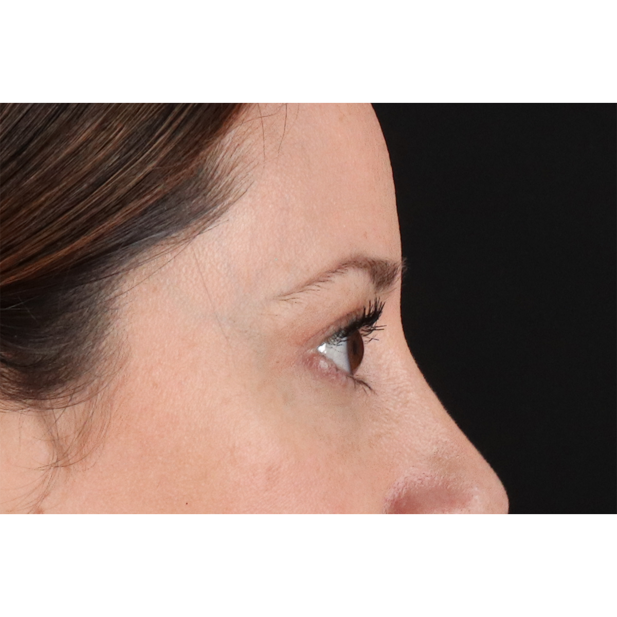 Eyelid Surgery Before & After Patient #3006