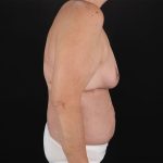 Breast Reduction with Lift Before & After Patient #3007