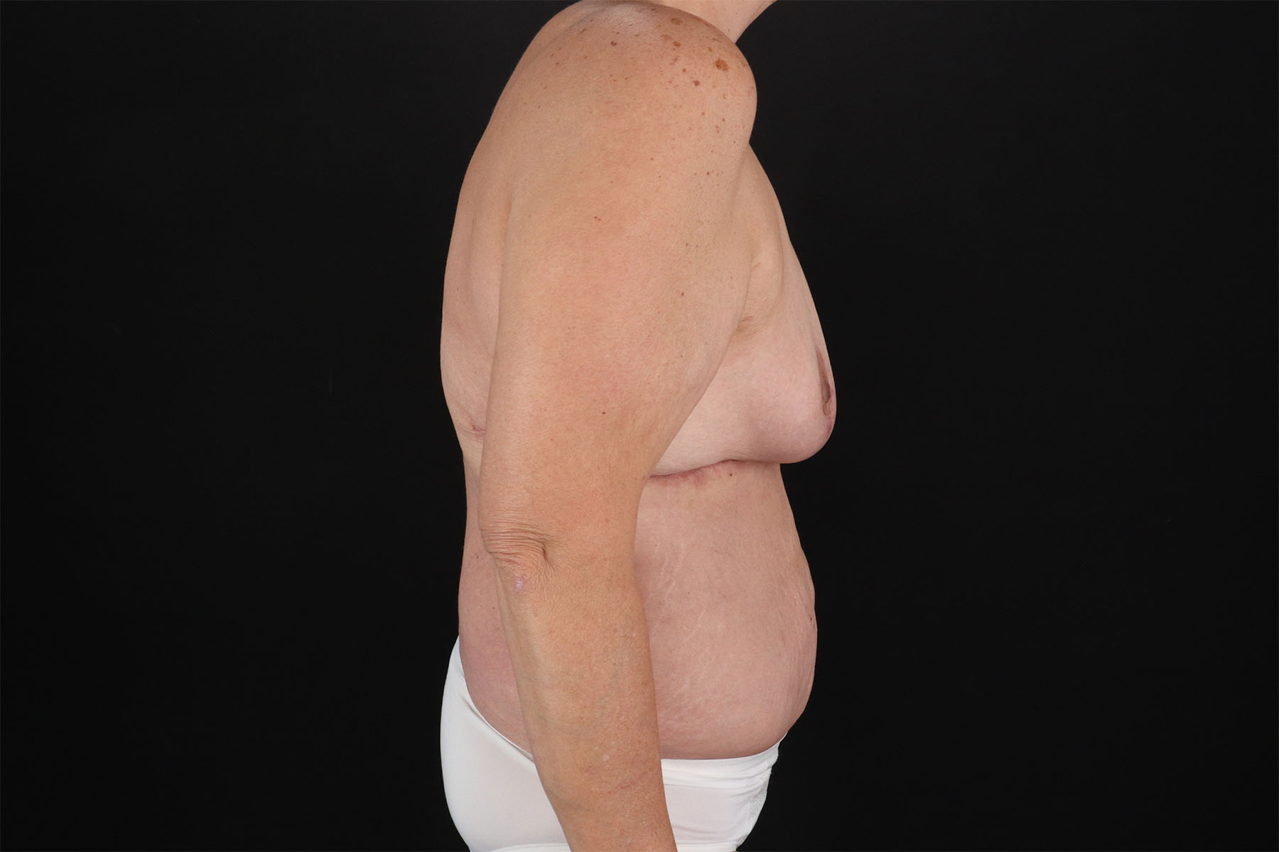 Breast Reduction with Lift Before & After Patient #3007