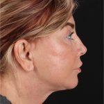 Neck Lift Before & After Patient #3476