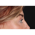 Eyelid Surgery Before & After Patient #3475