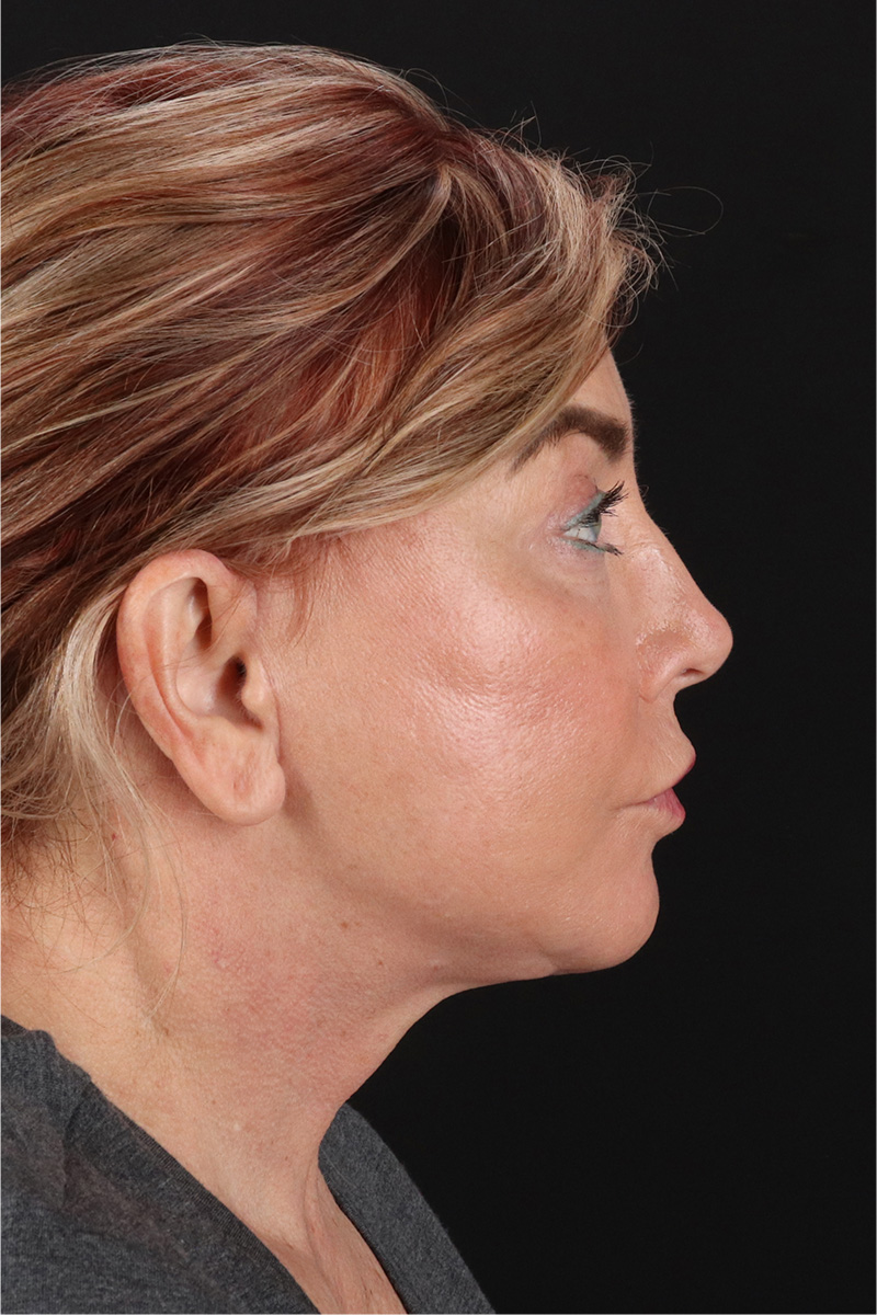 Neck Lift Before & After Patient #3476