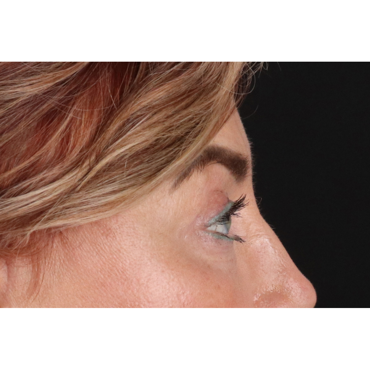 Eyelid Surgery Before & After Patient #3475