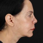 Structural Fat Grafting Before & After Patient #3645
