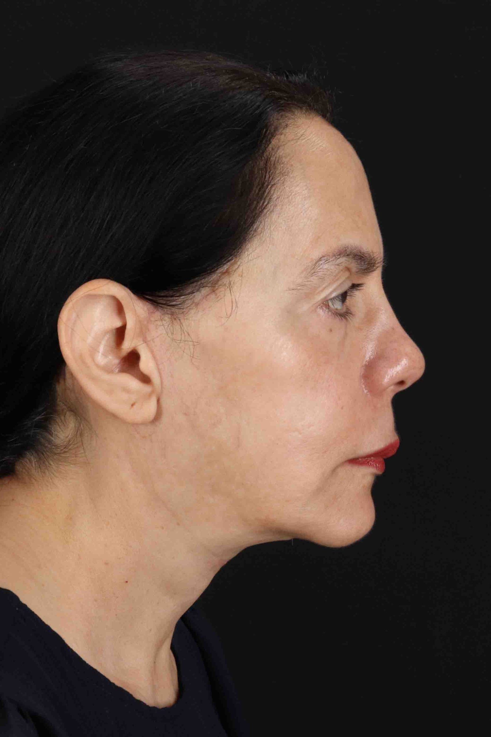 Structural Fat Grafting Before & After Patient #3645