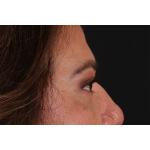 Eyelid Surgery Before & After Patient #3008