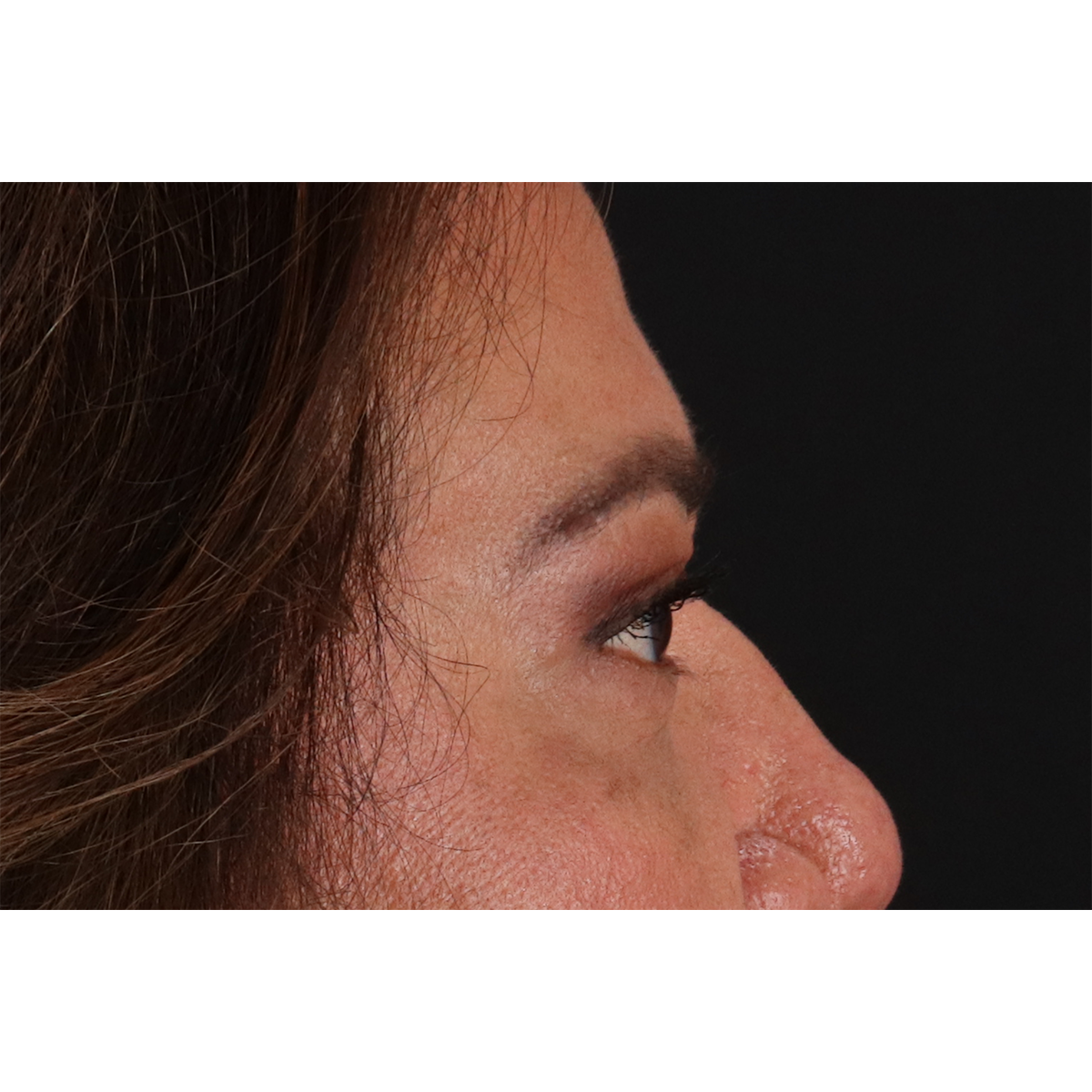 Eyelid Surgery Before & After Patient #3008