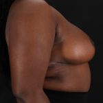 Breast Reduction with Lift Before & After Patient #3478