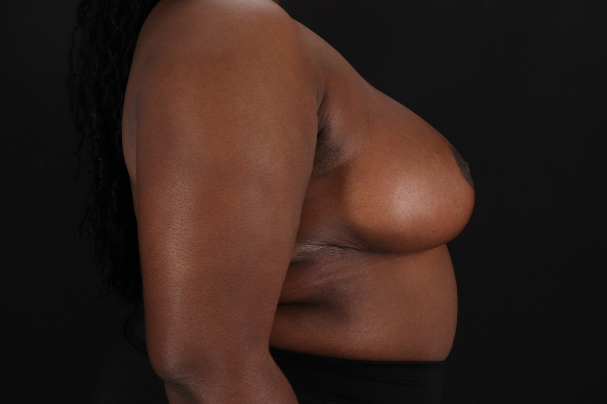Breast Reduction with Lift Before & After Patient #3478