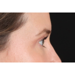 Eyelid Surgery Before & After Patient #3570