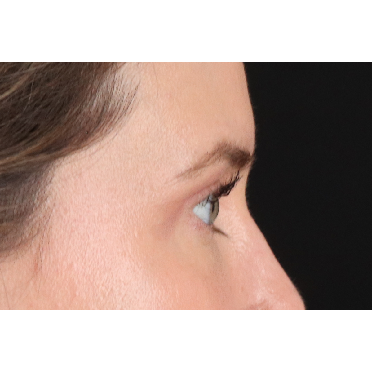 Eyelid Surgery Before & After Patient #3570