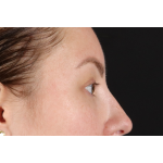 Brow Lift Before & After Patient #3111