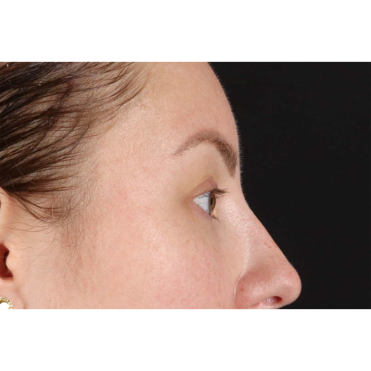 Brow Lift Before & After Patient #3111
