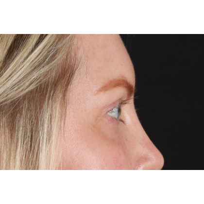 Eyelid Surgery Before & After Patient #3112