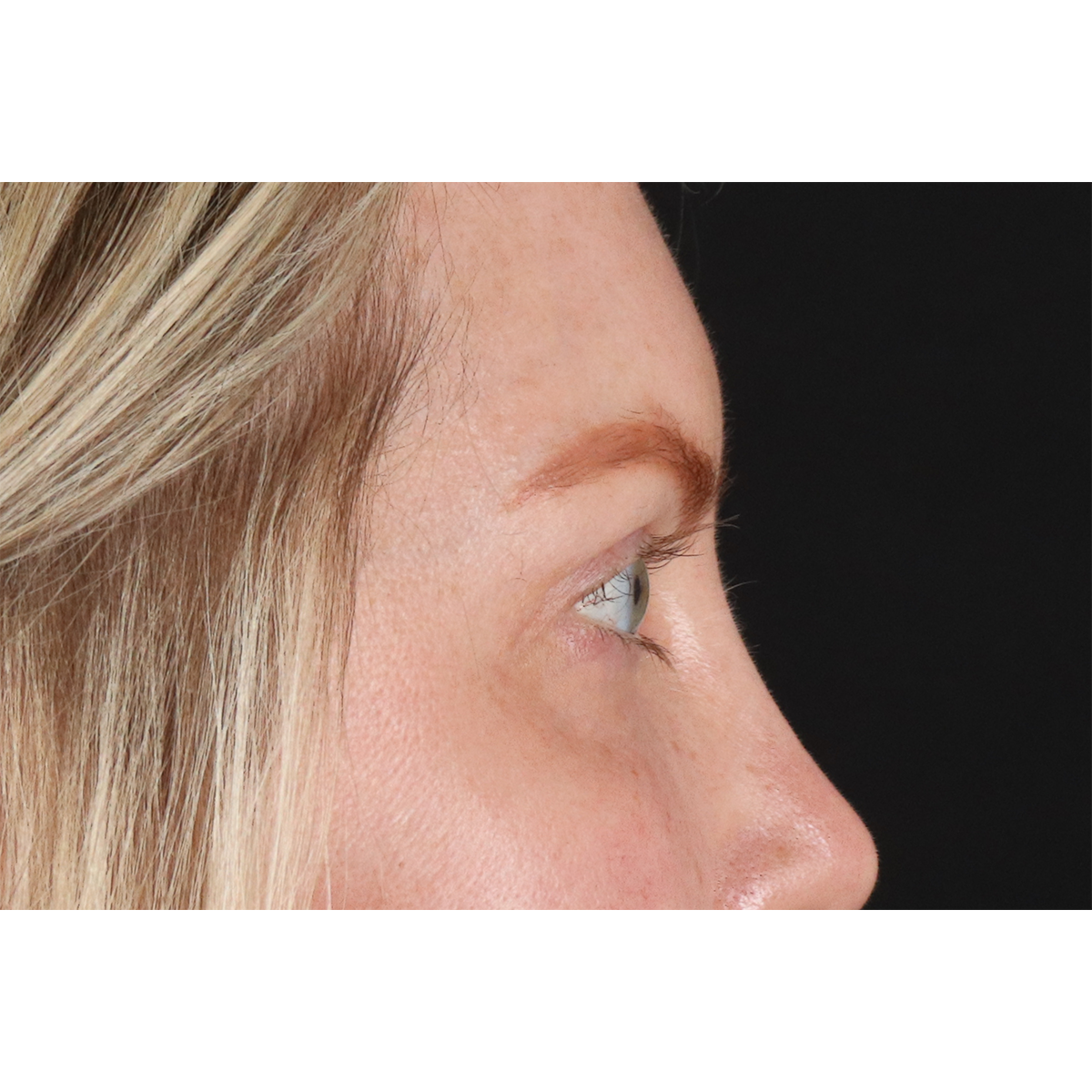 Eyelid Surgery Before & After Patient #3112