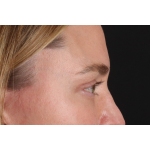Eyelid Surgery Before & After Patient #3571
