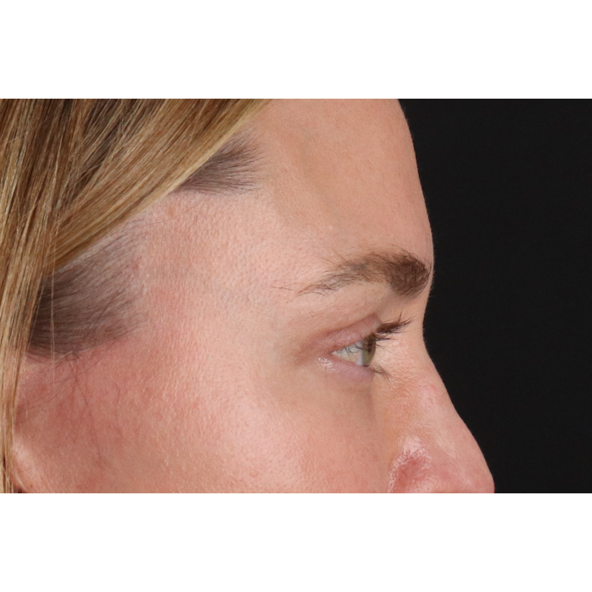 Eyelid Surgery Before & After Patient #3571
