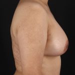 Breast Augmentation with Implants Before & After Patient #3573
