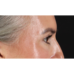 Eyelid Surgery Before & After Patient #3356