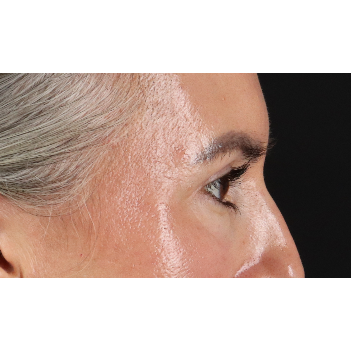 Eyelid Surgery Before & After Patient #3356