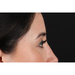 Eyelid Surgery Before & After Patient #3358