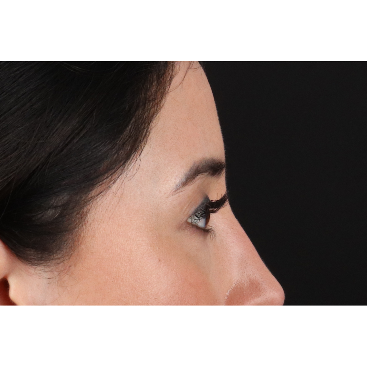 Eyelid Surgery Before & After Patient #3358
