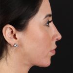 Structural Fat Grafting Before & After Patient #3649