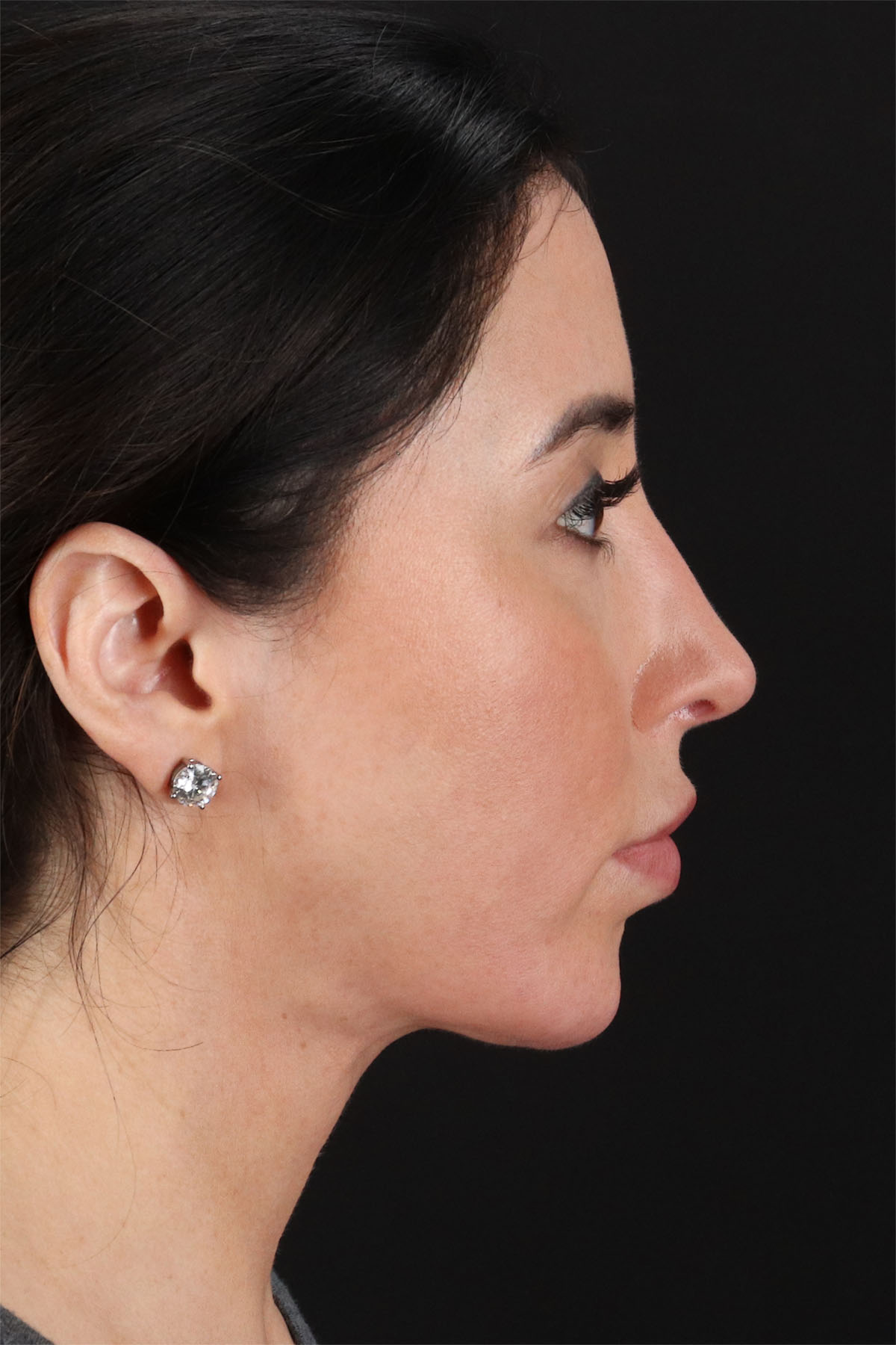 Structural Fat Grafting Before & After Patient #3649