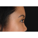 Brow Lift Before & After Patient #3114