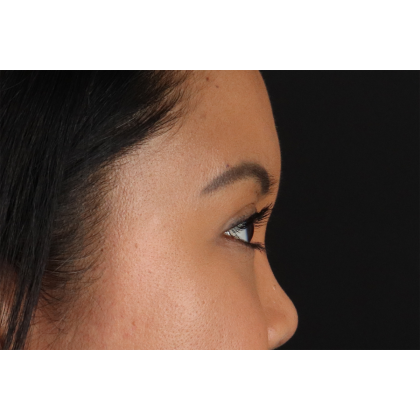 Brow Lift Before & After Patient #3114