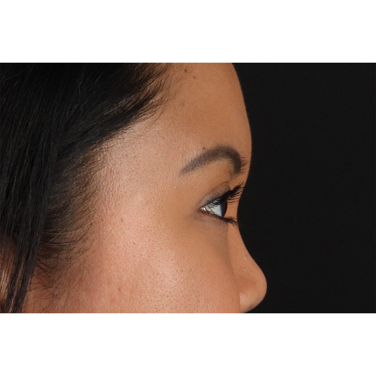 Brow Lift Before & After Patient #3114