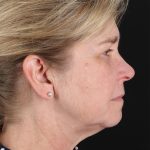 CO2 Laser Before & After Patient #3116