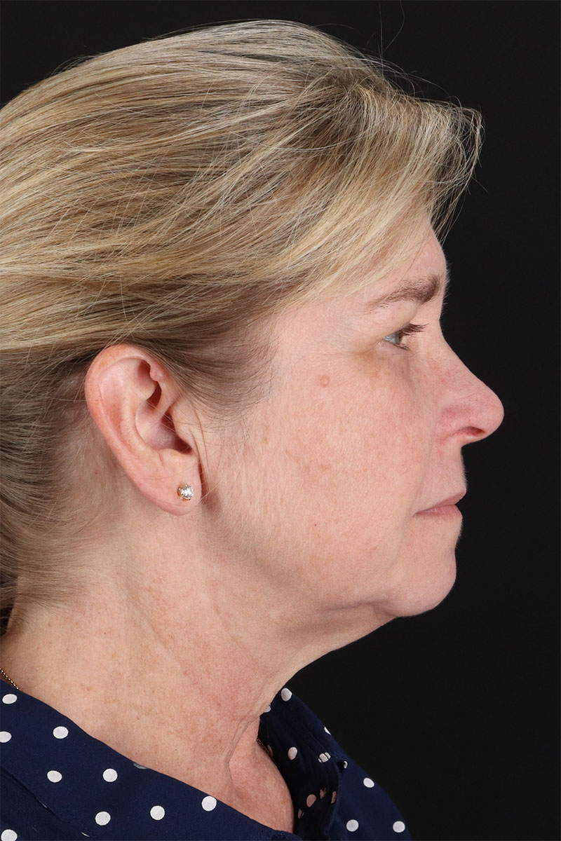 CO2 Laser Before & After Patient #3116