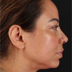 Laser Before & After Patient #3359