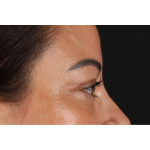 Eyelid Surgery Before & After Patient #3360