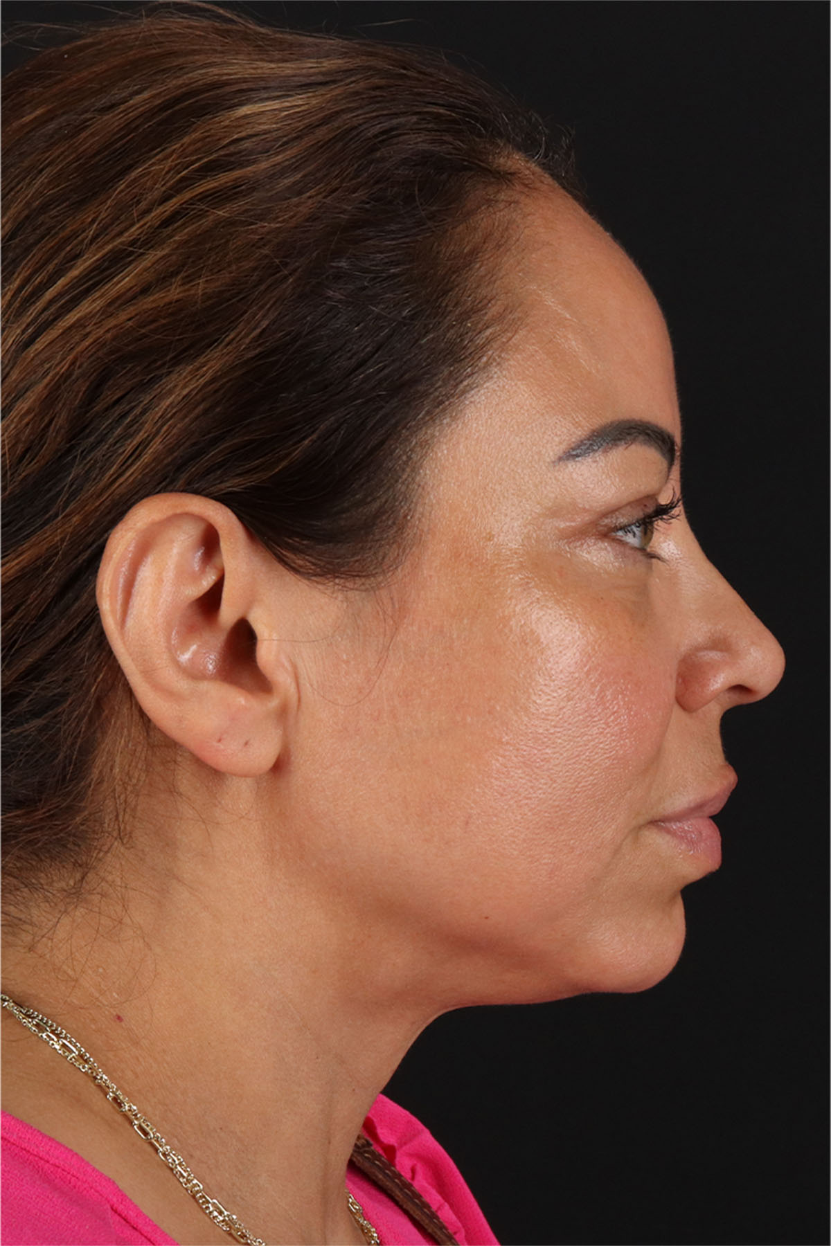Laser Before & After Patient #3359