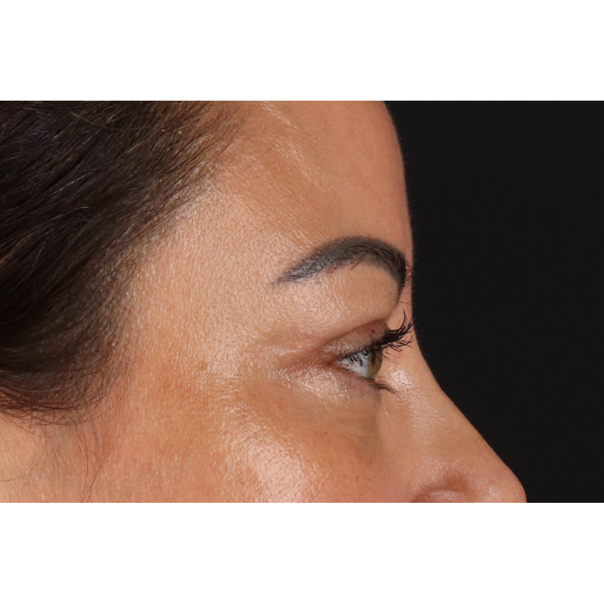 Eyelid Surgery Before & After Patient #3360