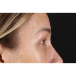 Eyelid Surgery Before & After Patient #3361