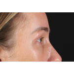 Eyelid Surgery Before & After Patient #3361